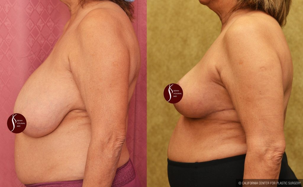 Breast Reduction Before & After Patient #14259