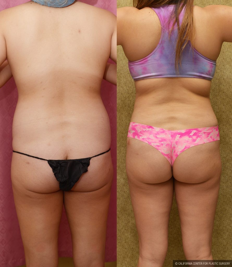 Tummy Tuck (Abdominoplasty) Medium Size Before & After Patient #14265