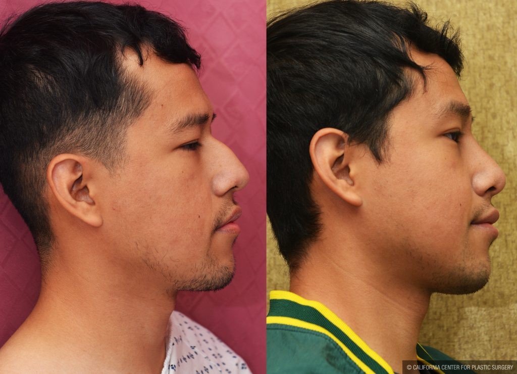 Rhinoplasty - Asian Before & After Patient #14264