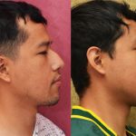 Rhinoplasty - Asian Before & After Patient #14264