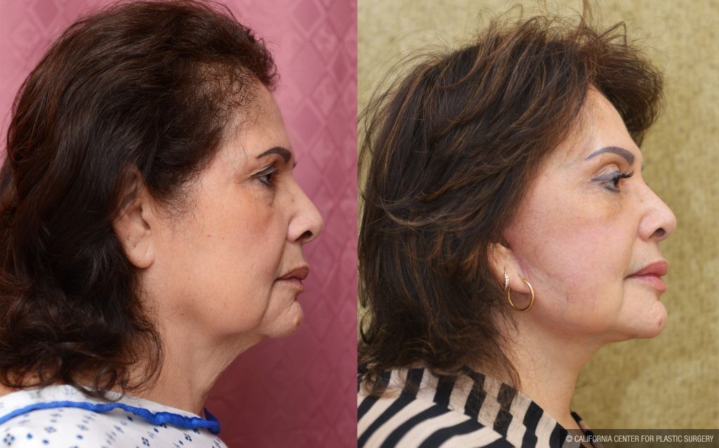 Eyelid (Blepharoplasty) Before & After Patient #14263